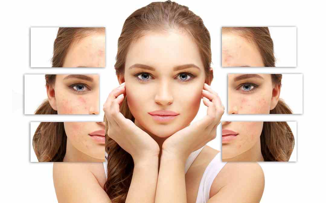 Peelings para pele com acne
